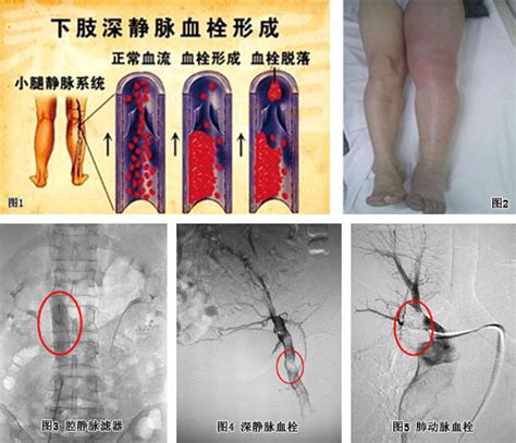 下肢動脈栓塞可以溶栓嗎