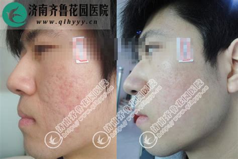 激光治療痤瘡大概需要多少錢