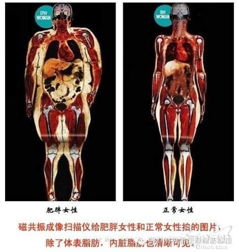 抽脂豐胸一般需要多少錢