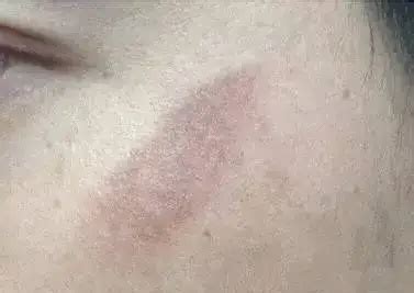 金屬化后的皮膚會留下不良后果嗎