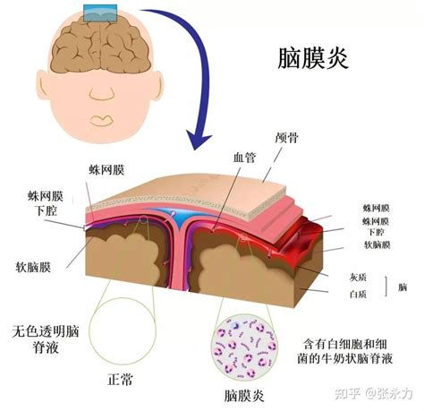 腦膜炎的主要癥狀