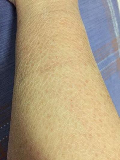 淋病是什么癥狀