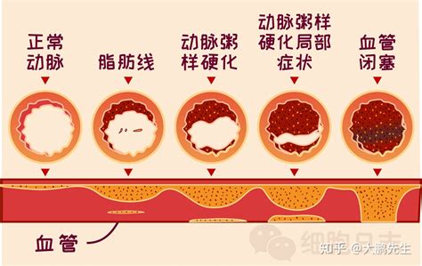 乳糜血是怎么回事