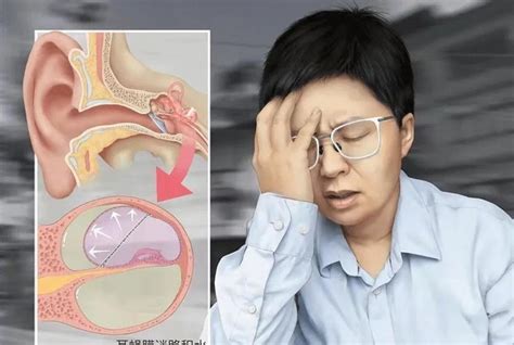 梅麗爾綜合癥 美尼爾氏綜合癥的癥狀