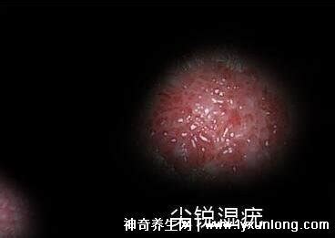 男性尖銳濕尤圖初期圖片,出現(xiàn)淡色成簇的贅生小疙瘩就要注意了
