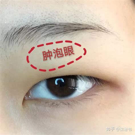 開(kāi)眼角和割雙眼皮有什么區(qū)別