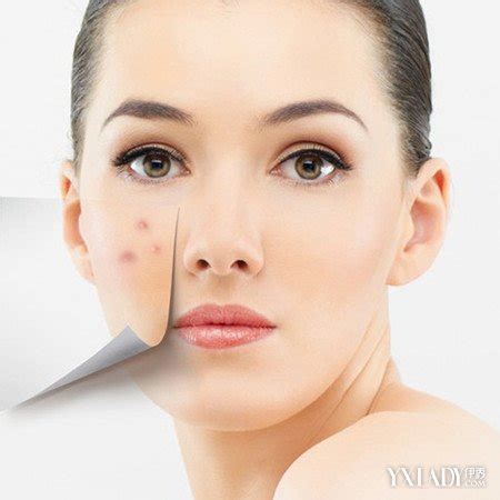 痘疤怎么消除 這些妙招趕緊學(xué)起來吧