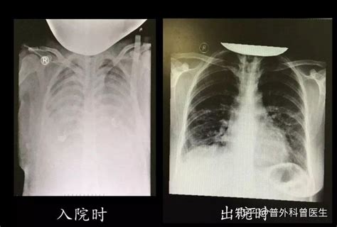 白肺的早期癥狀有哪些