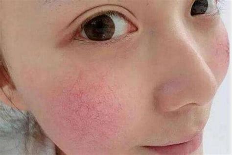 如何去紅血絲 6大秘方去除臉上紅血絲