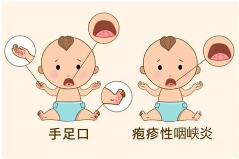 手足口病潛伏期多久才會(huì)發(fā)病
