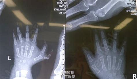 多指切除術 具體是怎樣的