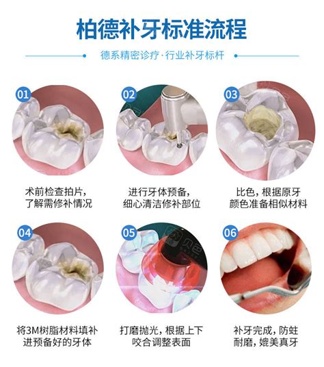 樹脂補(bǔ)牙過程圖解(補(bǔ)牙過程圖解)