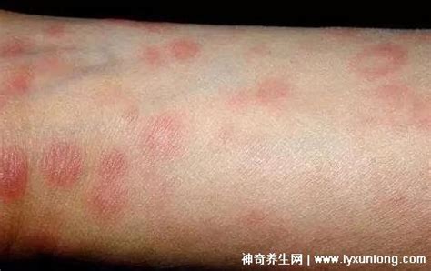 初期梅毒疹圖片癥狀,軀干上的斑疹/皮疹/膿瘡蔓延至手腳心