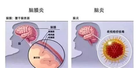 什么是散發(fā)性腦炎