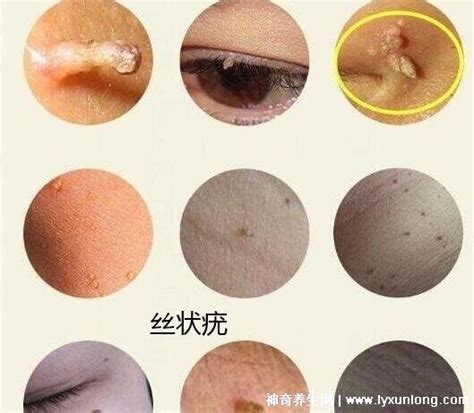 假疣和真疣的區(qū)別圖,真疣初期癥狀非常明顯(男女都容易被傳染)