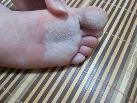 各種腳氣的癥狀圖片大全,水皰型最癢傳染性最強(qiáng)(附根治法)